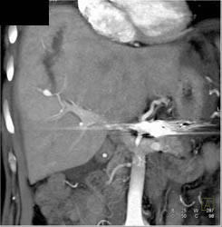 Liver Laceration and Hepatic Artery Aneurysm - CTisus CT Scan