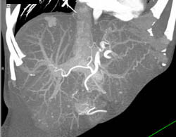 Focal Nodular Hyperplasia (FNH) - CTisus CT Scan