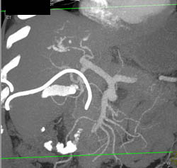 Cholangiocarcinoma - CTisus CT Scan