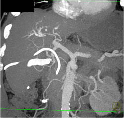 Cholangiocarcinoma - CTisus CT Scan