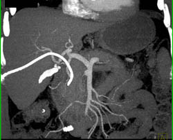 Cholangiocarcinoma - CTisus CT Scan