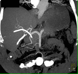 Cholangiocarcinoma - CTisus CT Scan