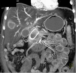 Metastases in A Fatty Liver - CTisus CT Scan