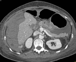 Perihepatic and Subcapsular Bleed - CTisus CT Scan