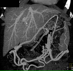 Cirrhosis With Varices - CTisus CT Scan