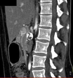 Hepatic Artery Aneurysm - CTisus CT Scan