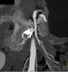 Hepatic Artery Aneurysm - CTisus CT Scan