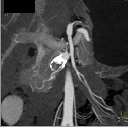 Hepatic Artery Aneurysm - CTisus CT Scan