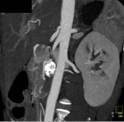 Hepatic Artery Aneurysm - CTisus CT Scan