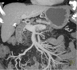 Partial Portal Vein Thrombosis (PVT) and Splenic and Superior Mesenteric Vein (SMV) Thrombosis - CTisus CT Scan