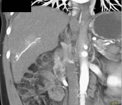 Hemangioma - CTisus CT Scan