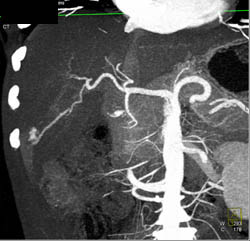 Hemangioma - CTisus CT Scan