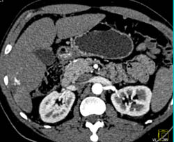 Hemangioma - CTisus CT Scan