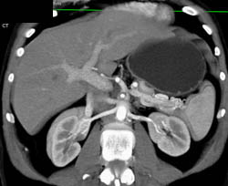 Focal Nodular Hyperplasia (FNH) - CTisus CT Scan