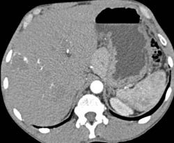 Hemangioma in 3D - CTisus CT Scan