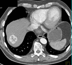 Vascular Metastases With Scar - CTisus CT Scan