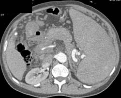 Portal Hypertension With Splenomegaly and Varices and Collaterals - CTisus CT Scan