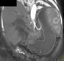 Occlusion of Hepatic Artery S/P Transplant With Liver Infarction - CTisus CT Scan