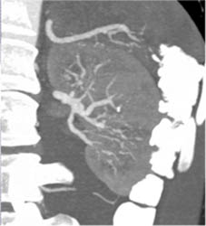 Polyarteritis Nodosa - CTisus CT Scan