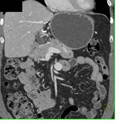 Superior Mesenteric Vein (SMV) Aneurysm - CTisus CT Scan