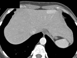 Focal Nodular Hyperplasia (FNH)- Multiple - CTisus CT Scan