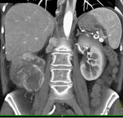 Renal Cell Carcinoma With Liver Metastases - CTisus CT Scan