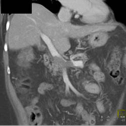 Clot in Portal Vein (PV) and Splenic Vein - CTisus CT Scan