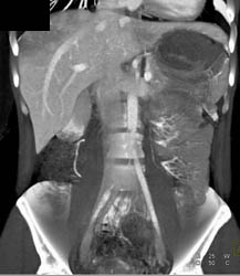 Focal Fat - CTisus CT Scan