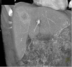 Liver Metastases - CTisus CT Scan