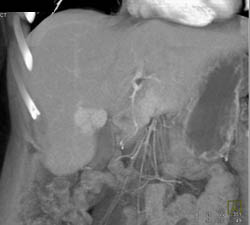 Focal Nodular Hyperplasia (FNH) - CTisus CT Scan