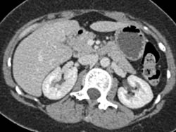 Focal Nodular Hyperplasia (FNH) - CTisus CT Scan