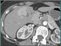 Focal Nodular Hyperplasia (FNH) - CTisus CT Scan