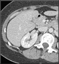 Focal Nodular Hyperplasia (FNH) - CTisus CT Scan