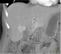 Focal Nodular Hyperplasia (FNH) - CTisus CT Scan