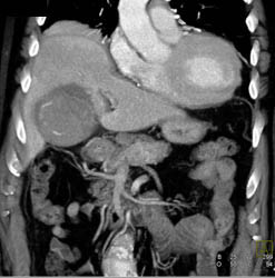 Acute Cholecystitis - CTisus CT Scan