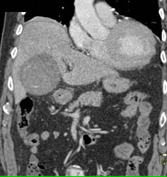 Acute Cholecystitis - CTisus CT Scan