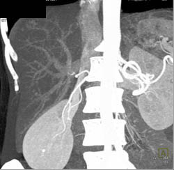 Focal Nodular Hyperplasia (FNH) - CTisus CT Scan