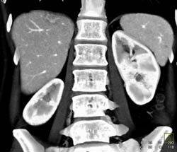 Focal Nodular Hyperplasia (FNH) - CTisus CT Scan