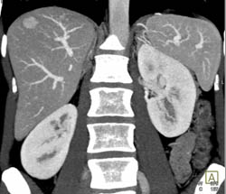 Focal Nodular Hyperplasia (FNH) - CTisus CT Scan