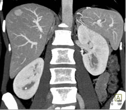 Focal Nodular Hyperplasia (FNH) - CTisus CT Scan