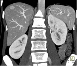 Focal Nodular Hyperplasia (FNH) - CTisus CT Scan