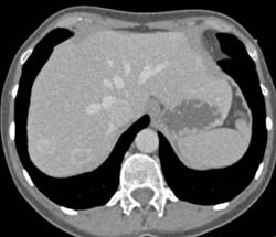 Focal Nodular Hyperplasia (FNH) - CTisus CT Scan