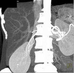 Focal Nodular Hyperplasia (FNH) - CTisus CT Scan