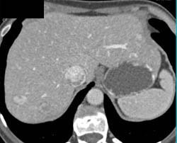 Focal Nodular Hyperplasia (FNH) - CTisus CT Scan