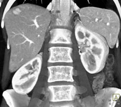 Focal Nodular Hyperplasia (FNH) - CTisus CT Scan