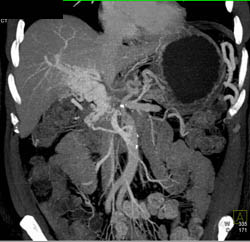 Cavernous Trnasformation of the Portal Vein With Portal Vein (PV) Occlusion - CTisus CT Scan