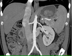 Focal Nodular Hyperplasia (FNH) - CTisus CT Scan