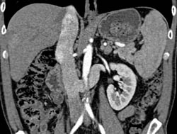 Focal Nodular Hyperplasia (FNH) - CTisus CT Scan