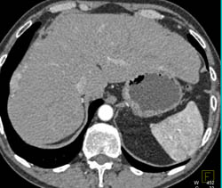 Hepatic Implants - CTisus CT Scan