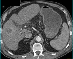 Hepatoma - CTisus CT Scan